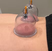 Cupping Therapy