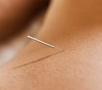 Dry Needling